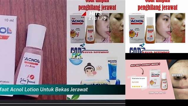 Temukan 5 Manfaat Acnol Lotion untuk Bekas Jerawat yang Jarang Diketahui